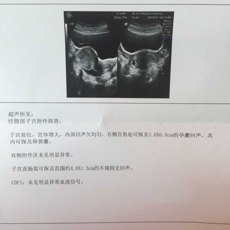 广州供卵助孕包成功,广州试管